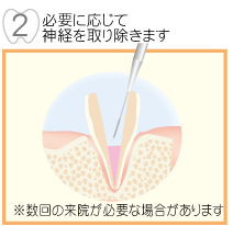 必要に応じて神経を取り除きます