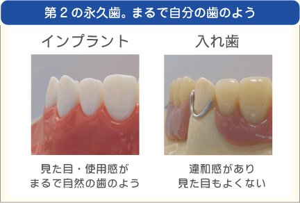 第２の永久歯　まるで自分の歯のよう